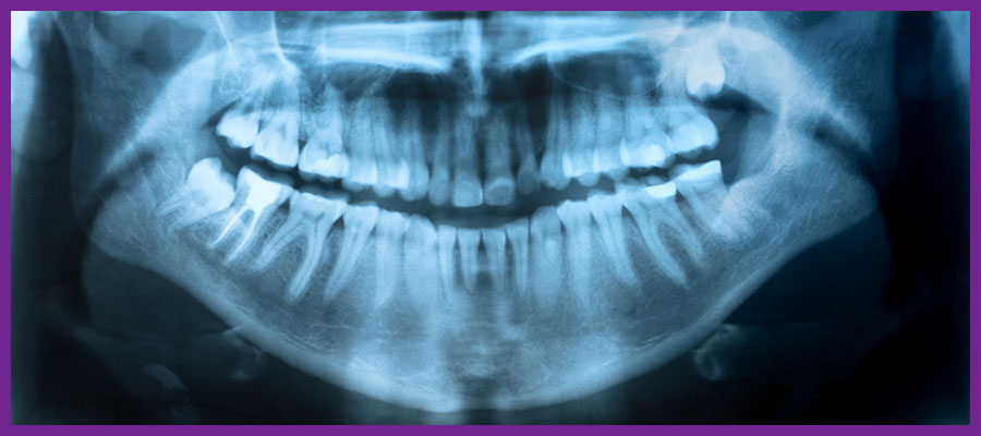 Dental-X-rays1