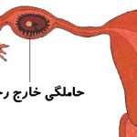 حاملگی خارج از رحم چیست؟/ نشانه ها و درمان این نوع حاملگی