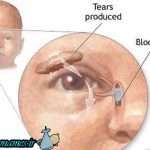 انسداد مجرای اشکی در نوزادان