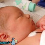 کم کاری تیروئید در نوزادان