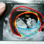 هماتوم در بارداری چیست و چه علائمی دارد؟